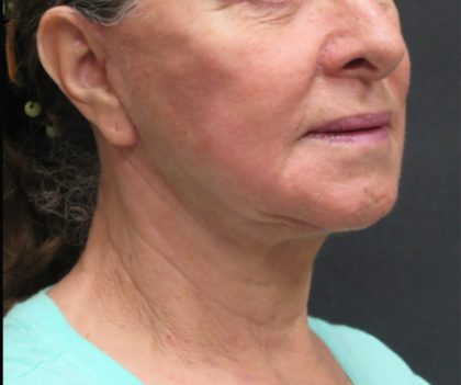 Facelift Before & After Patient #1639