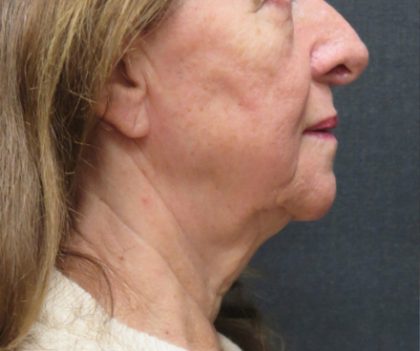 Facelift Before & After Patient #1639