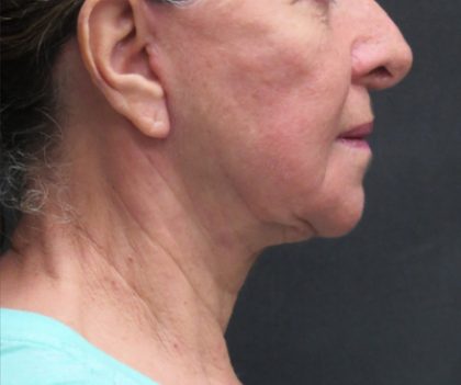 Facelift Before & After Patient #1639