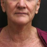 Facelift Before & After Patient #1650