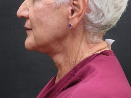Facelift Before & After Patient #1650