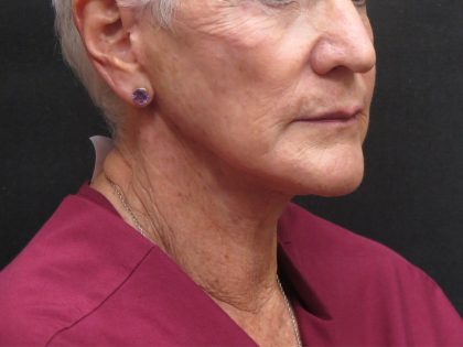 Facelift Before & After Patient #1650