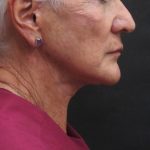 Facelift Before & After Patient #1650