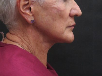 Facelift Before & After Patient #1650