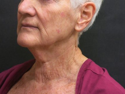 Facelift Before & After Patient #1650