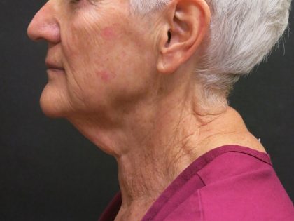 Facelift Before & After Patient #1650