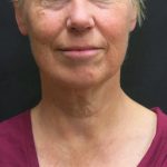 Facelift Before & After Patient #1661