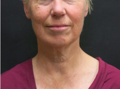 Facelift Before & After Patient #1661