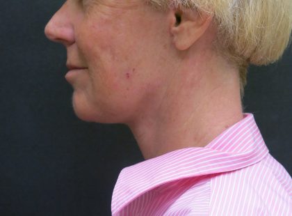 Facelift Before & After Patient #1661