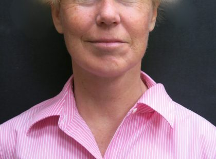 Facelift Before & After Patient #1661