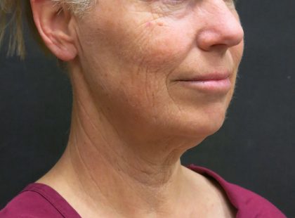 Facelift Before & After Patient #1661