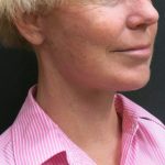 Facelift Before & After Patient #1661