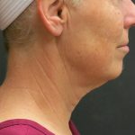 Facelift Before & After Patient #1661