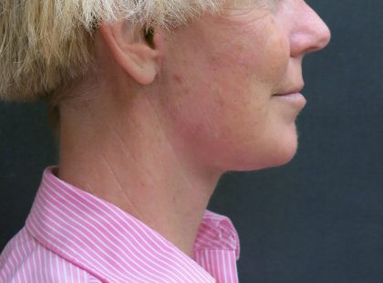 Facelift Before & After Patient #1661
