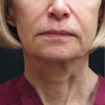 Facelift Before & After Patient #1672