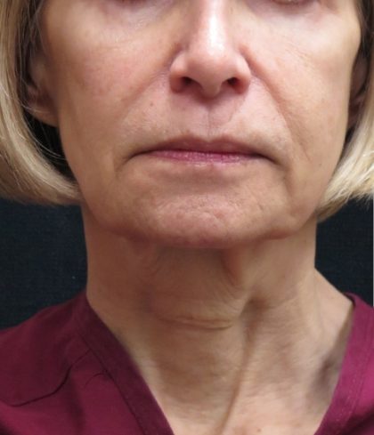 Facelift Before & After Patient #1672