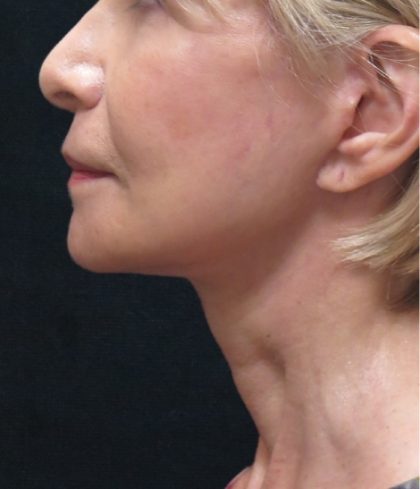Facelift Before & After Patient #1672