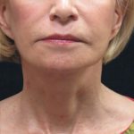 Facelift Before & After Patient #1672
