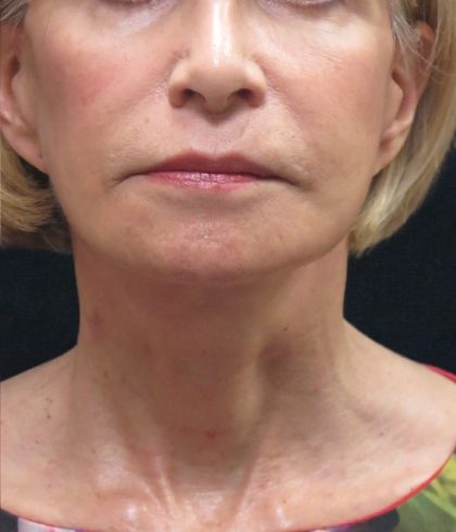 Facelift Before & After Patient #1672
