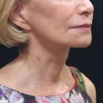 Facelift Before & After Patient #1672