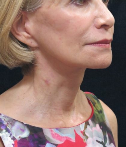 Facelift Before & After Patient #1672