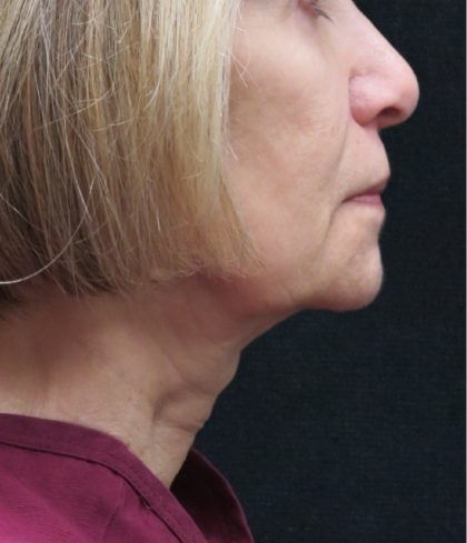 Facelift Before & After Patient #1672