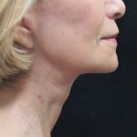 Facelift Before & After Patient #1672