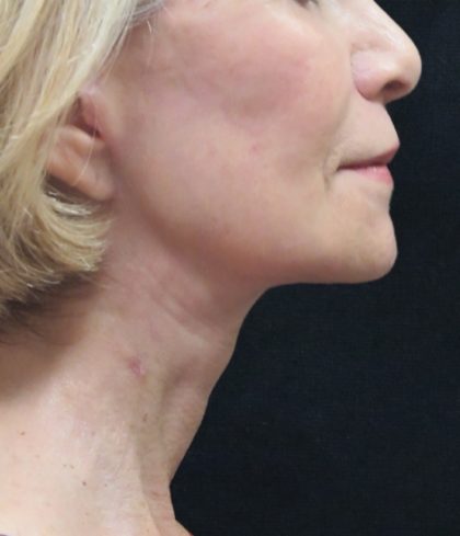 Facelift Before & After Patient #1672