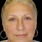 Facelift Before & After Patient #1679