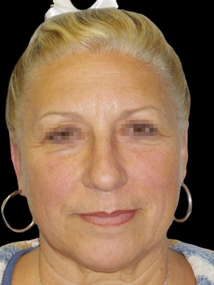 Facelift Before & After Patient #1679