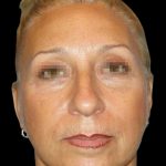 Facelift Before & After Patient #1679