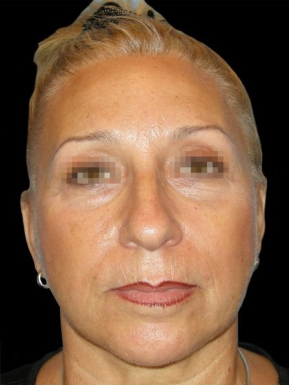 Facelift Before & After Patient #1679