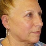 Facelift Before & After Patient #1679