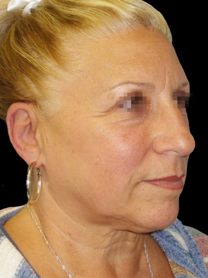 Facelift Before & After Patient #1679