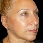 Facelift Before & After Patient #1679