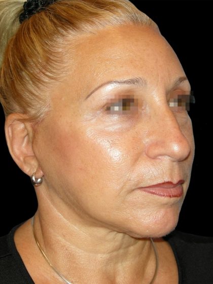 Facelift Before & After Patient #1679