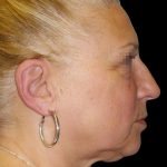 Facelift Before & After Patient #1679