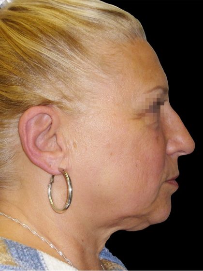 Facelift Before & After Patient #1679