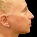 Facelift Before & After Patient #1679