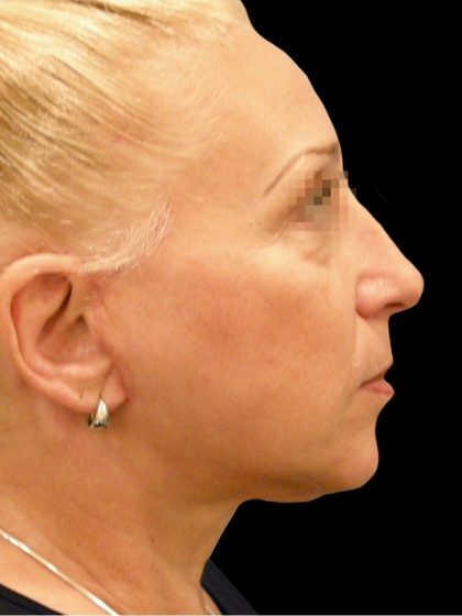 Facelift Before & After Patient #1679