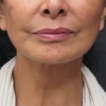 Facelift Before & After Patient #1697