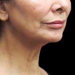 Facelift Before & After Patient #1697
