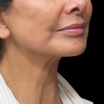 Facelift Before & After Patient #1697