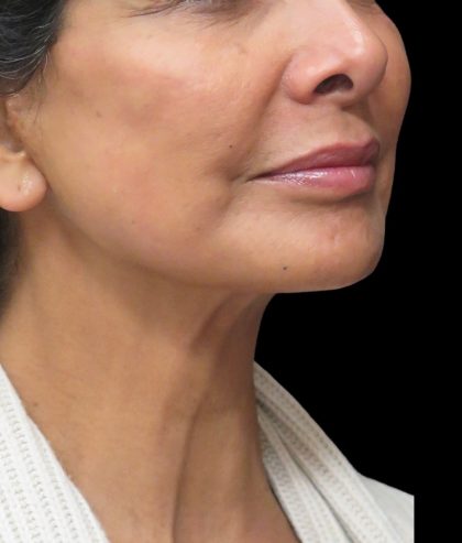 Facelift Before & After Patient #1697