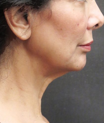 Facelift Before & After Patient #1697