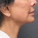 Facelift Before & After Patient #1697