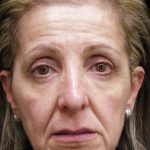 Facelift Before & After Patient #1702