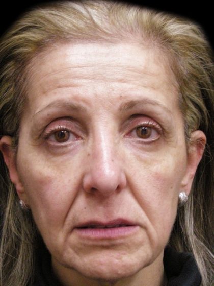 Facelift Before & After Patient #1702