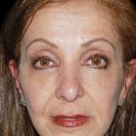Facelift Before & After Patient #1702