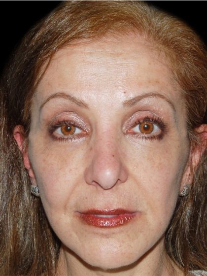 Facelift Before & After Patient #1702